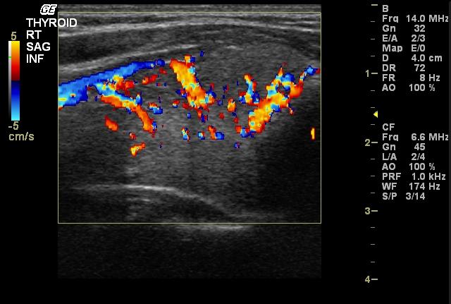 Thyroid Ultrasound